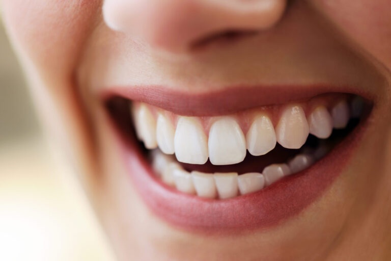Afbeelding van behandeling Botox gummysmile tandvleeslach