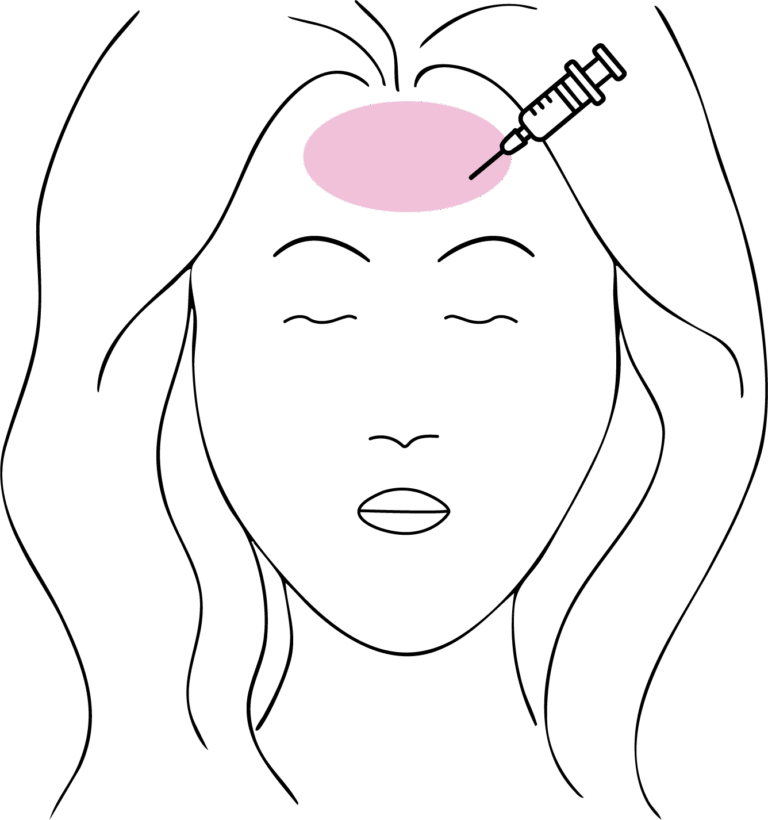 Afbeelding van behandeling Botox voorhoofd